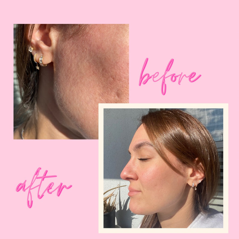 before and after of dermaplaning at home using eco-friendly derma razors from about the glow
